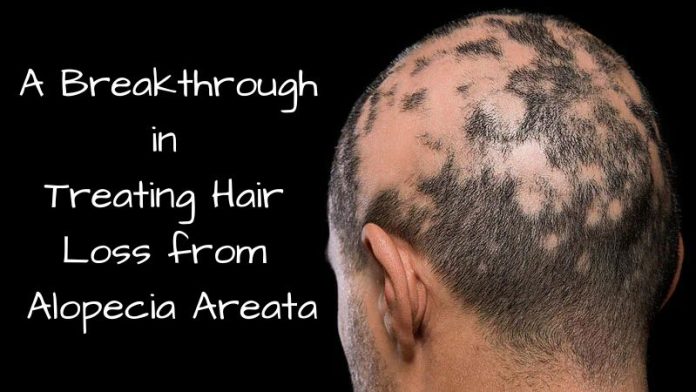 A Breakthrough in Treating Hair Loss from Alopecia Areata