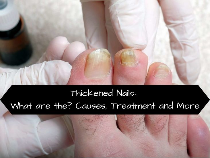 Thickened Nails: What are the? Causes, Treatment and More